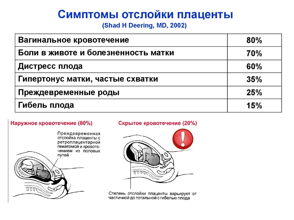 отслойка плаценты на поздних сроках беременности